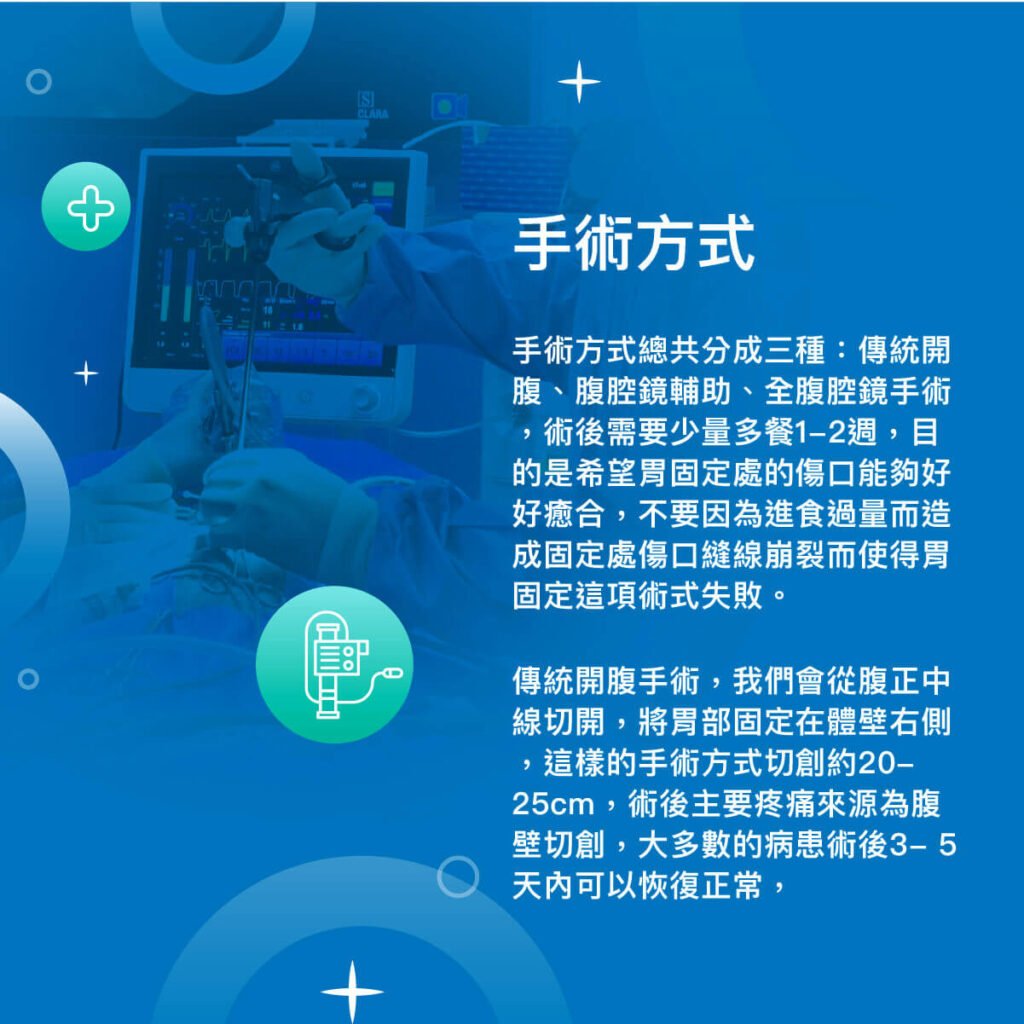 全腹腔鏡胃固定術