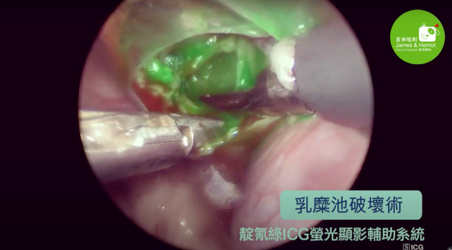 Step2：進行腹腔鏡乳糜池破壞術